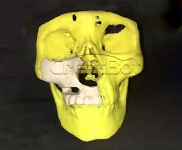 Humerus and upper jawbone PEEK implant 02