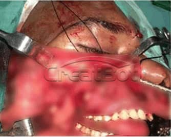 Humerus and upper jawbone PEEK implant 04