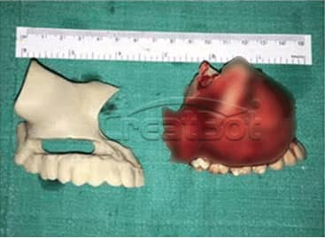 Humerus and upper jawbone PEEK implant 05