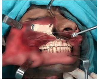 Humerus and upper jawbone PEEK implant 06