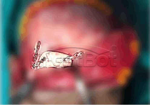 Brow ridge PEEK implant 01