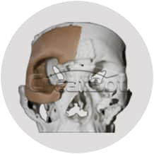 {{$t('peek-medical-case.osLacrimale.alt1')}}