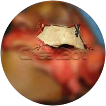 {{$t('peek-medical-case.osLacrimale.alt8')}}
