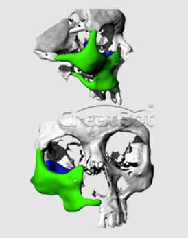 Os lacrimale and cheekbone PEEK implant 11