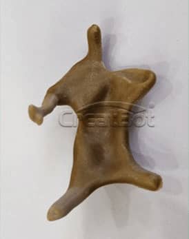 Os lacrimale and cheekbone PEEK implant 12
