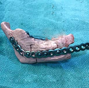 Lower jawbone PEEK implant 04
