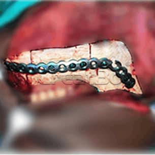Lower jawbone PEEK implant 05