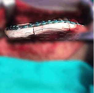 Lower jawbone PEEK implant 06