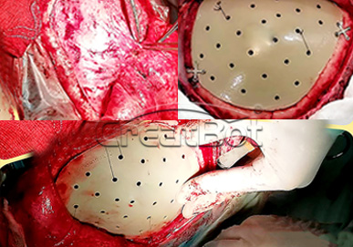 {{$t('peek-medical-case.cranium.alt7')}}